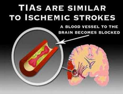 Symptoms of Stroke (Stroke #3)