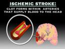 Understanding Stroke (Stroke #1)