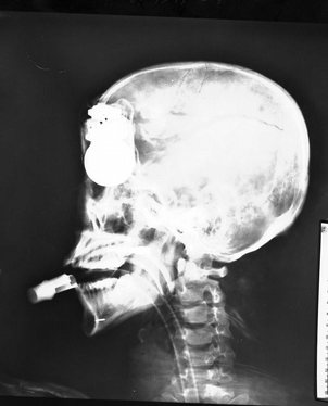 An X-ray from the Vietnam war shows an unexploded grenade embedded in a patient's skull. (As demonstrated by the intubation, the patient is lying down, not standing up. The circumstances behind the image are otherwise unknown.)