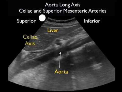 Aorta Ultrasound - Introduction - SonoSite, Inc.