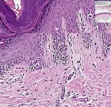 Histopathology Skin--Melanoma in situ