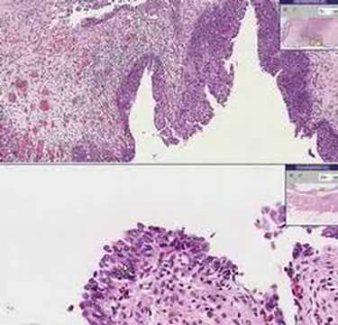 Histopathology Bladder Transitional Carcinoma-in-situ