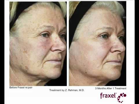 Fraxel-re-pair-before-and-after- photos NYC - (212) 644-9494 - New York, NY