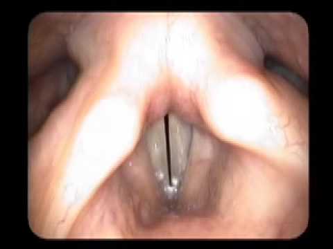 Video Stroboscopy of the Vocal Cords