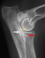 Fragmentation of the medial coronoid process