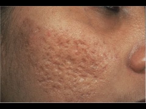 Removing Acne Scars [DermTV.com #61]