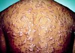 Reddish papules and nodules over much of the body due to Secondary syphilis occurs approximately four to ten weeks after the primary infection.