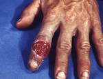 Primary chancre of syphilis on the hand. Primary syphilis is typically acquired via direct sexual contact with the infectious lesions of another person.