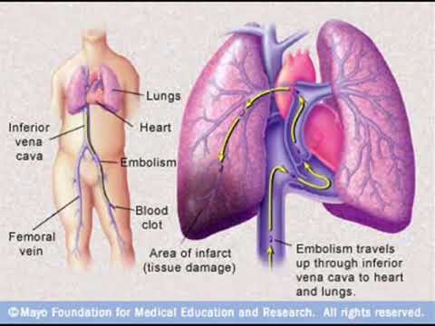 Pulmonary Embolism