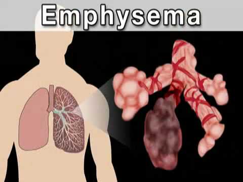 What is Chronic Bronchitis?