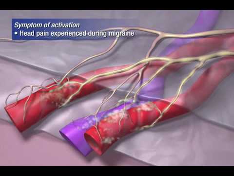 Migraine Pathophysiology