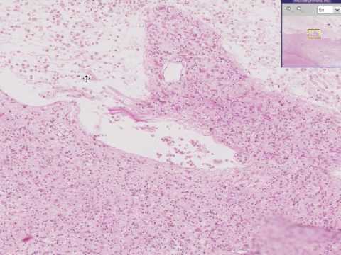 Histopathology, Brain --Cerebral infarct, recent