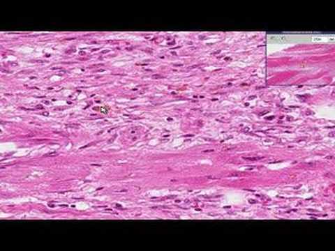 Histopathology Heart --Myocardial infarction, recent