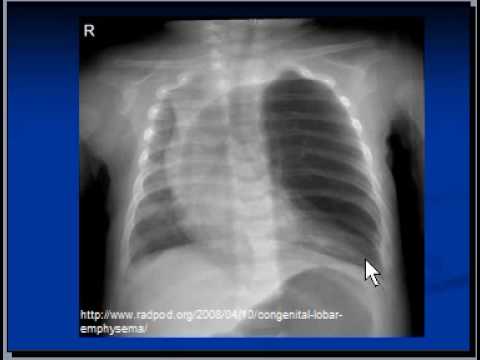 Chest x-ray, Congenital lobar emphysema