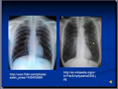 Chest x-ray interpretation --COPD and Emphysema