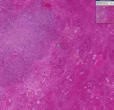 Histopathology Liver--Cirrhosis, hepatocellular carcinoma