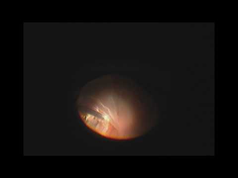 Vitrectomy and Perfluoron for Retinal Detachment with Giant Retinal Tear