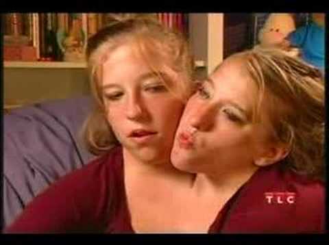 Conjoined Twins, Abby & Brittany Hensel turn 16