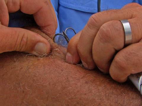 Angler Sticks Hook in Arm to Demonstrate Amazing Hook Removal Technique