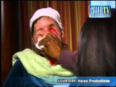 Charla Nash Shows Her Face to Oprah After Being Attacked By A Chimp