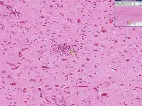 Histopathology Brain --Viral encephalitis