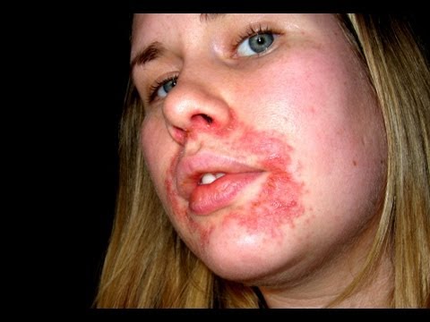 MRSA CURE - Staph Infection on Face