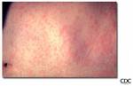 measles - disease - affect the skin - wn/aruna