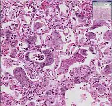 Histopathology Lung--Measles pneumonia