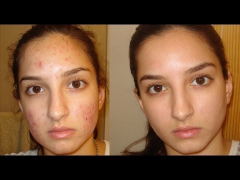 A true miracle- How I got rid of my acne. Daily skin-care routine.