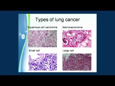 Improving Access to Treatment for Lung Cancer Patients