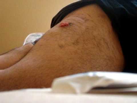 AK 47 gunshot wound