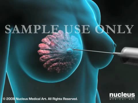 Breast Tissue Biopsy