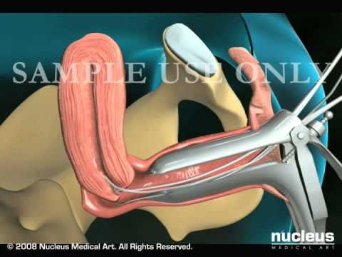 Endometrial Biopsy of the Uterus