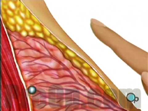 Patient Education Breast Biopsy Incisional Surgery