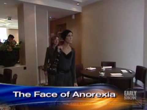 Anorexia's Living Face (CBS News)