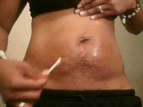 25% tca peel on stretch marks