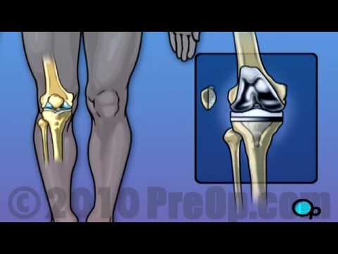 Knee Replacement Surgery PreOp® Patient Education