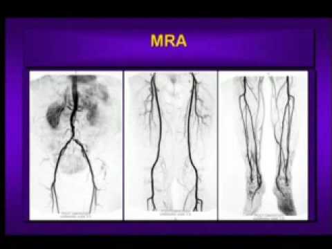 What is Peripheral Arterial Disease?