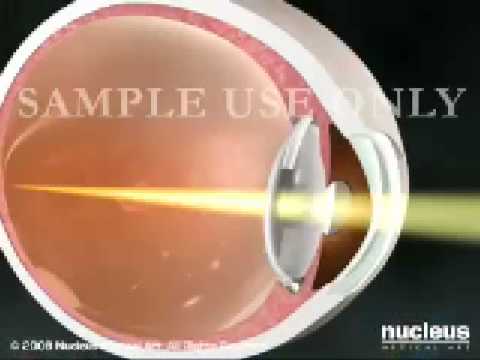 Cataract Surgery