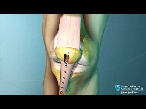 Anterior Cruciate Ligament (ACL) Reconstruction Animation