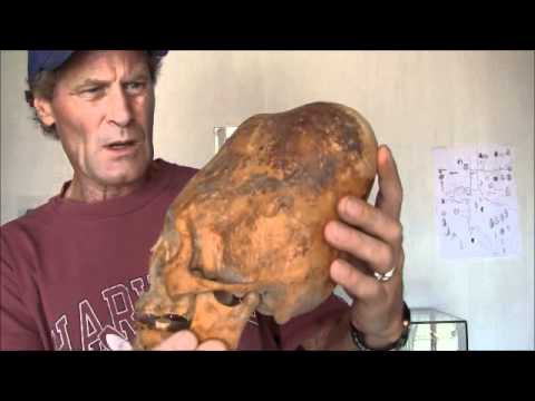 Enormous Cone Head Of Paracas Peru: Lost Human History Returns