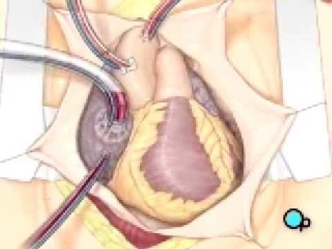 Malpractice Medical Coronary Artery Bypass Graft (CABG) Surgery 3