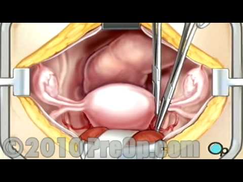 Hysterectomy Removal of the Uterus PreOp® Patient Education Feature