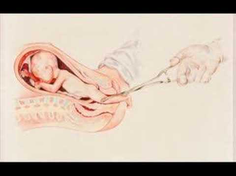 Partial-Birth Abortion Illustrated Video The Crime of Crimes / Pro-Life Anti-Abortion Film