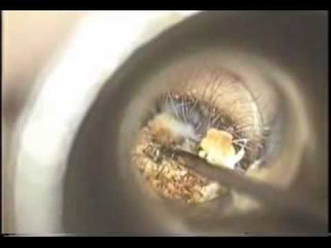 Ear wax removal