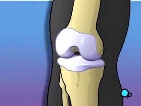 PreOp® Patient Education Arthroscopic Meniscus Repair, Knee