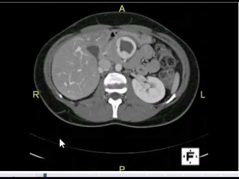 CT abdomen -Anatomy