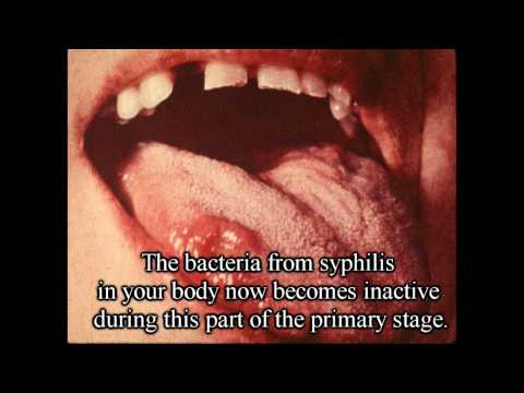 Learn About Syphilis