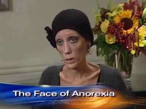 Anorexia's Living Face (CBS News)