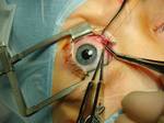 Strabismus surgery—medial rectus muscle being disinserted following pre-placement of vicryl sutures. A Castroviejo locking forceps is grasping the superior pole of the muscle, while a Manson-Aebli scissors does the cutting.